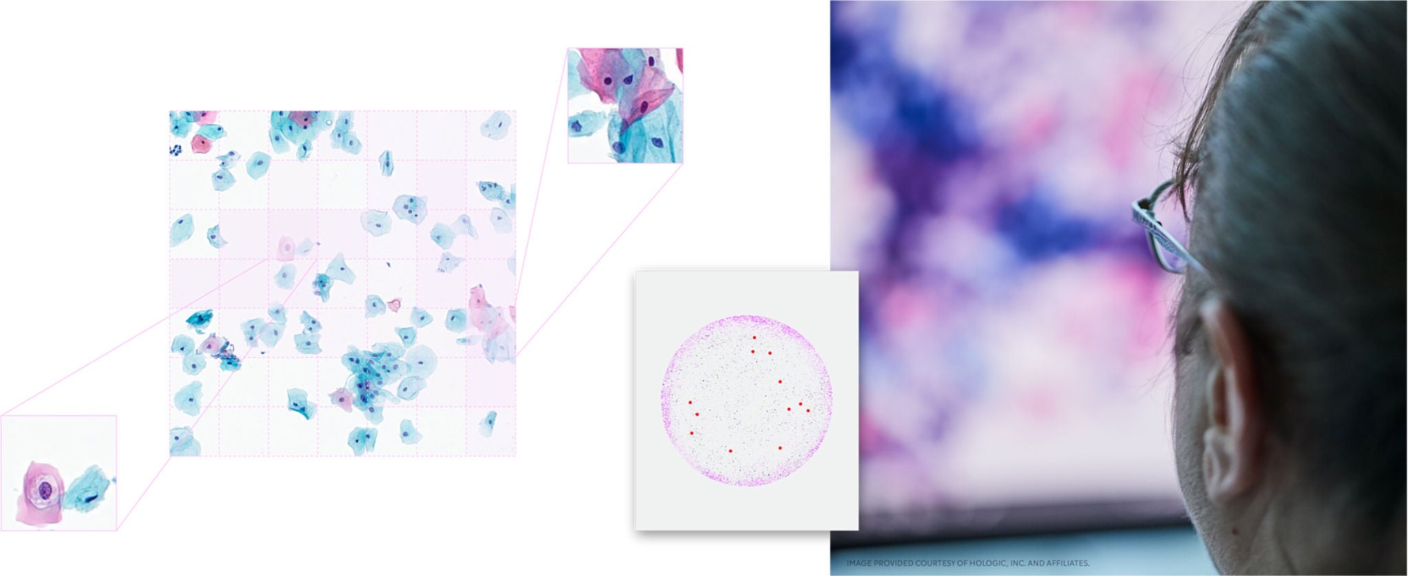 Story Hologic Cervical Screening Cancer Cell 2197x900 Collage of cancer cells and a technician reviewing image.